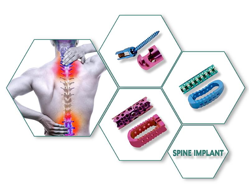 SPINE Implants